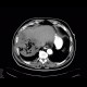 Gangrene of the liver: CT - Computed tomography